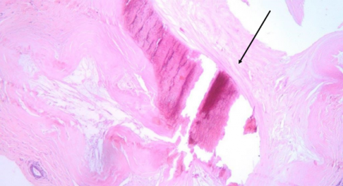 Immagine di una sezione istologica colorata in ematossilina-eosina di tessuto mammario contenente una microcalcificazione (indicata con la freccia nera)
