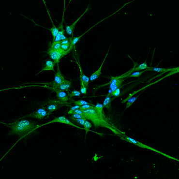 Colorazione (in verde) per il canale TMEM16B, un canale cloro attivato da calcio, su cellule di glioma derivate da paziente. I nuclei cellulari sono colorati in blu. Credits: Fabrizia Cesca, University of Trieste