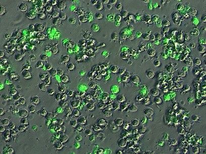 Cellule derivate da Leucemia linfocitaria cronica trattate con quercetina e con il farmaco apoptogenico ABT-737. In verde chiaro, le cellule tumorali morte