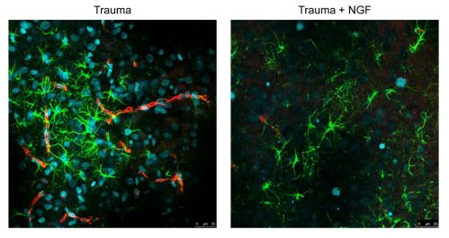 Riduzione del numero di astrociti (in verde) e microglia (in rosso) infiltrati nel parenchima cerebrale, a seguito della somministrazione di NGF per via intranasale