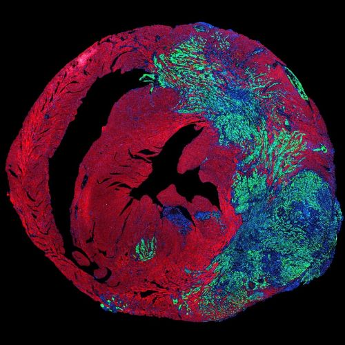 Immagine di cellule di tumore del polmone (in verde) che stanno crescendo all'interno di un cuore i cui cardiomiciti sono colorati in rosso, mentre i nuclei sono colorati in lbu
