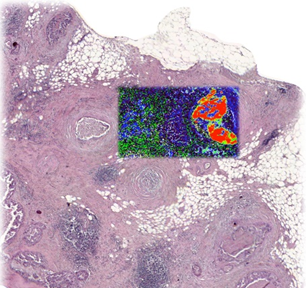 L'immagine mostra il vetrino istologico derivato dalla biopsia di un tumore. Nella zona colorata digitalmente si evidenzia in rosso la presenza di microcalcificazioni maligne