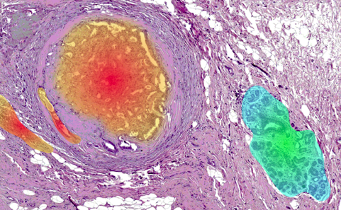 L'immagine a falsi-colori mostra il risultato ateso dal progetto: l'identificazione automatica, per mezzo di Raman imaging digitale, di regioni sane o tumorali eseguita su biopsia che non ha subito processi di colorazione